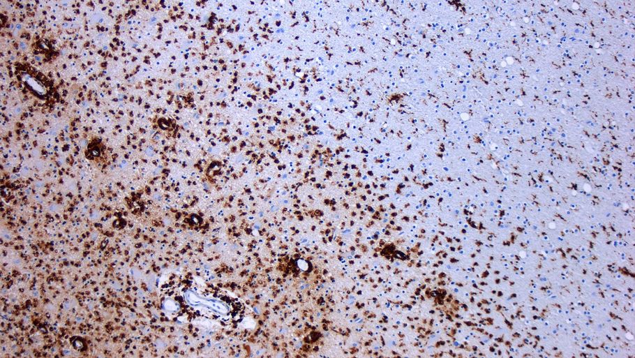 Sclerose er en sygdom i hvilken myelinskeder omkring hjernens og rygsøjlens axoner bliver beskadigede. Det fører til demyelinering, hvilket er afbilledet her (Foto: Marvin 101 (Wikimedia Commons))
