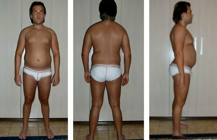 Rodrigo Alves måtte tage på i vægt, da han skulle bruge fedt til en stamcellebehandling. Foto: SWNS