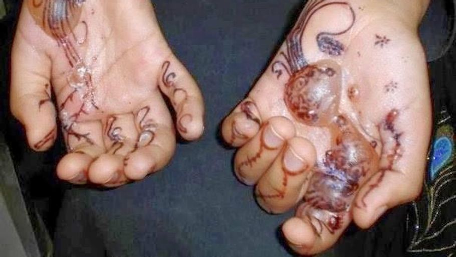 Henna-tatoveringer kan i værste fald udvikle blærer og voldsom eksem. Arkivfoto: Sahlgrenska Universitetssykehus/Facebook
