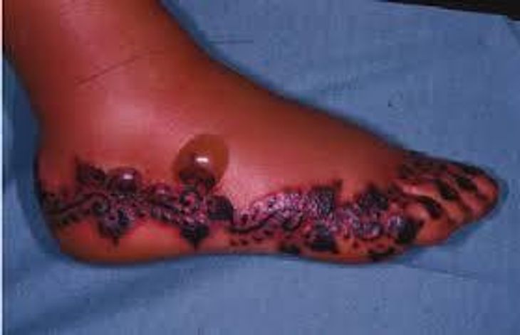 Her er endnu en person, der har fået en allergisk reaktion efter at have fået en henna-tatovering. Arkivoto: Sahlgrenska Universitetssykehus/Facebook