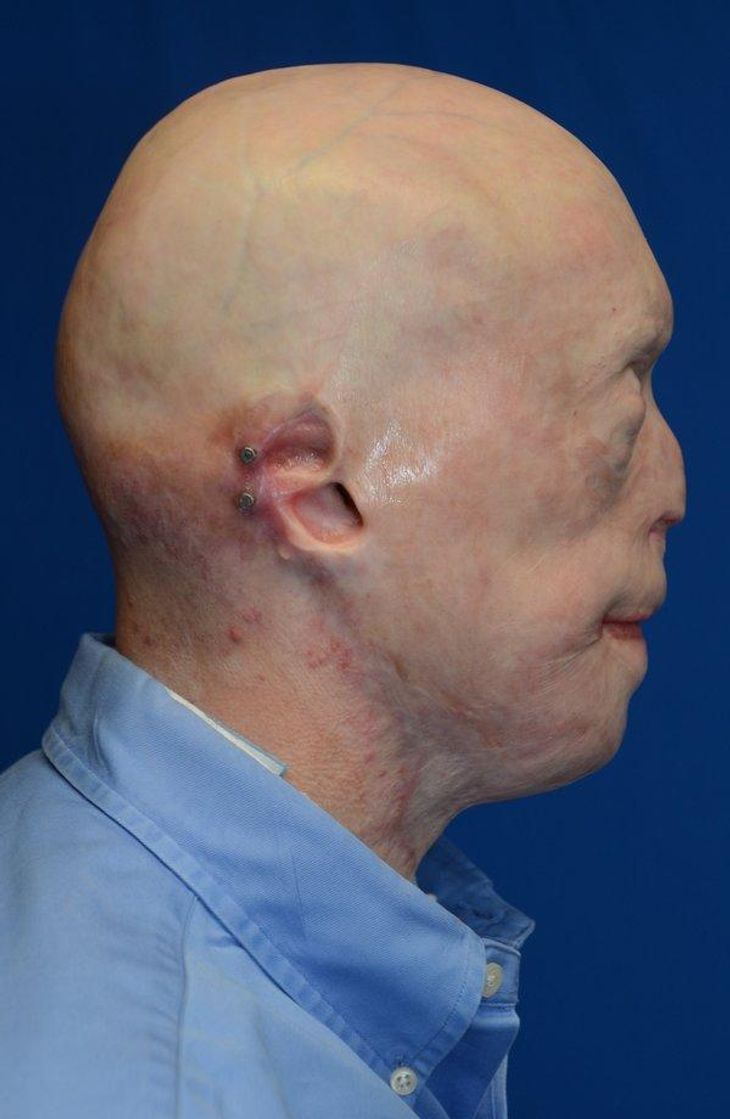 Patrick Hardison i profil før operationen. Foto: NYU Langone Medical Center