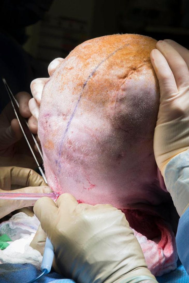 Her fjerner kirurgerne Patrick Hardisons hovedbund. Foto: NYU Langone Medical Center