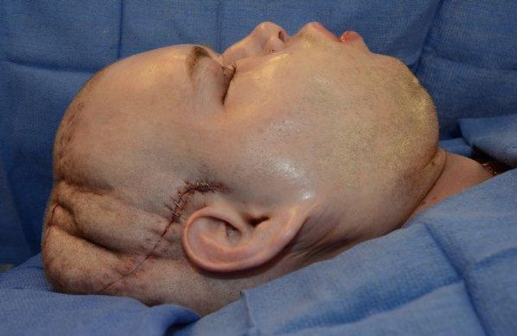 Lægerne havde forventet, at Patrick hardisons ansigt ville hæve. Foto: NYU Langone Medical Center