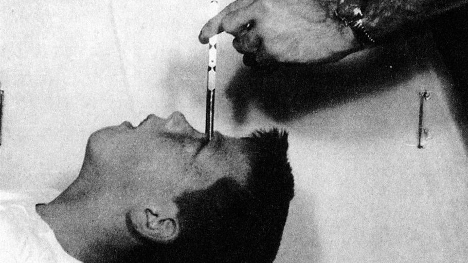 Det hvide snit bliver i dag kaldt en af videnskabens største fejltagelser. Alligevel har ingen af de 4500 danskere, der nåede at få opereret deres hjerner, inden man stoppede med at bruge behandlingen i 1983, fået erstatning eller undskyldning af staten. Foto: Fra 'Det hvide snit - psykokirurgi og dansk psykiatri 1922-1983' af Jesper V. Kragh.