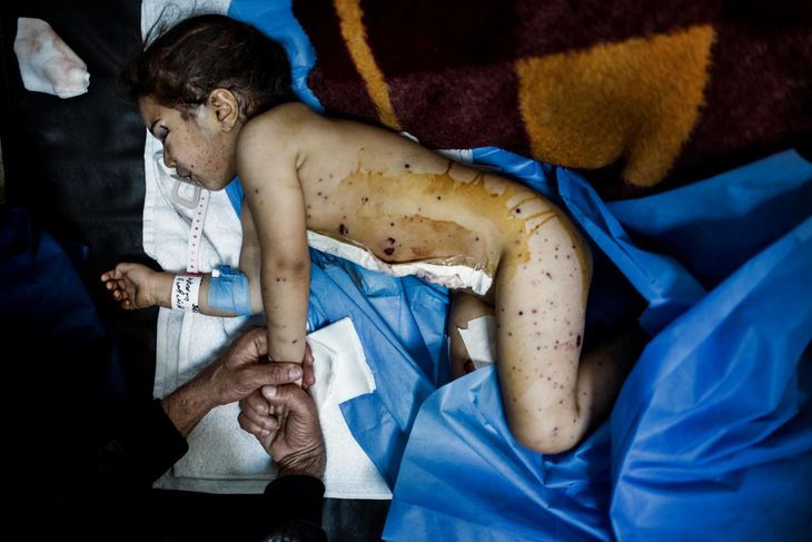 Treårige Narin, dagen efter morterangrebet i Mosul. Hendes krop er plettet af granatsplintre, og maven skåret op pga. nattens operation. Lægen har netop syet såret ved hendes øje. Men granatsplinten i hendes hjernen er for kompliceret at operere ud. Foto: Rasmus Flindt Pedersen