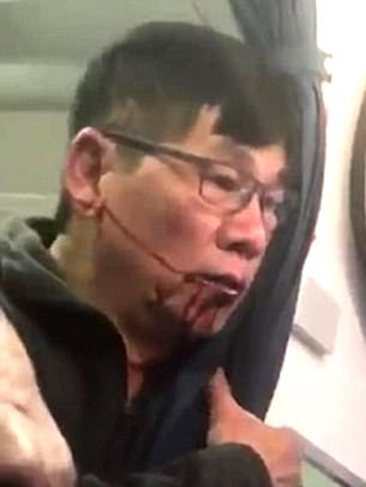 Doktor David Dao fik en ordentlig omgang på vej ud af flyet i sidste uge. Udover en brækket næse mistede han også flere tænder.