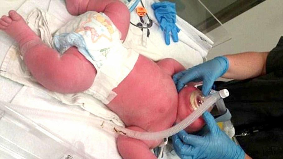 Sådan ser den nyfødte kæmpe baby ud. 57 centimerter lang og en vægt på 7,3 kilo. (foto: Stuff.co.nz)