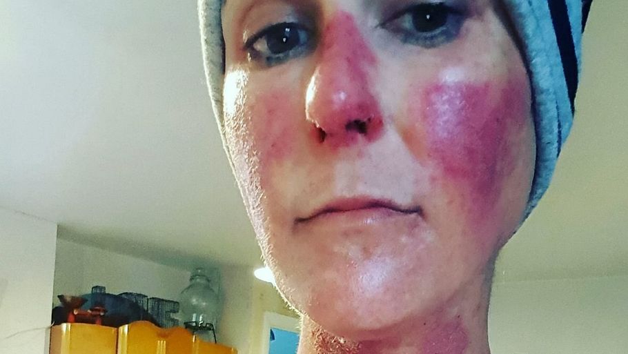 Laura Harris blev behandlet med kemoterapi mod sin tarmkræft. Det påvirkede hendes hud således, som det kan ses på billedet. (Foto: Ritzau/Scanpix)