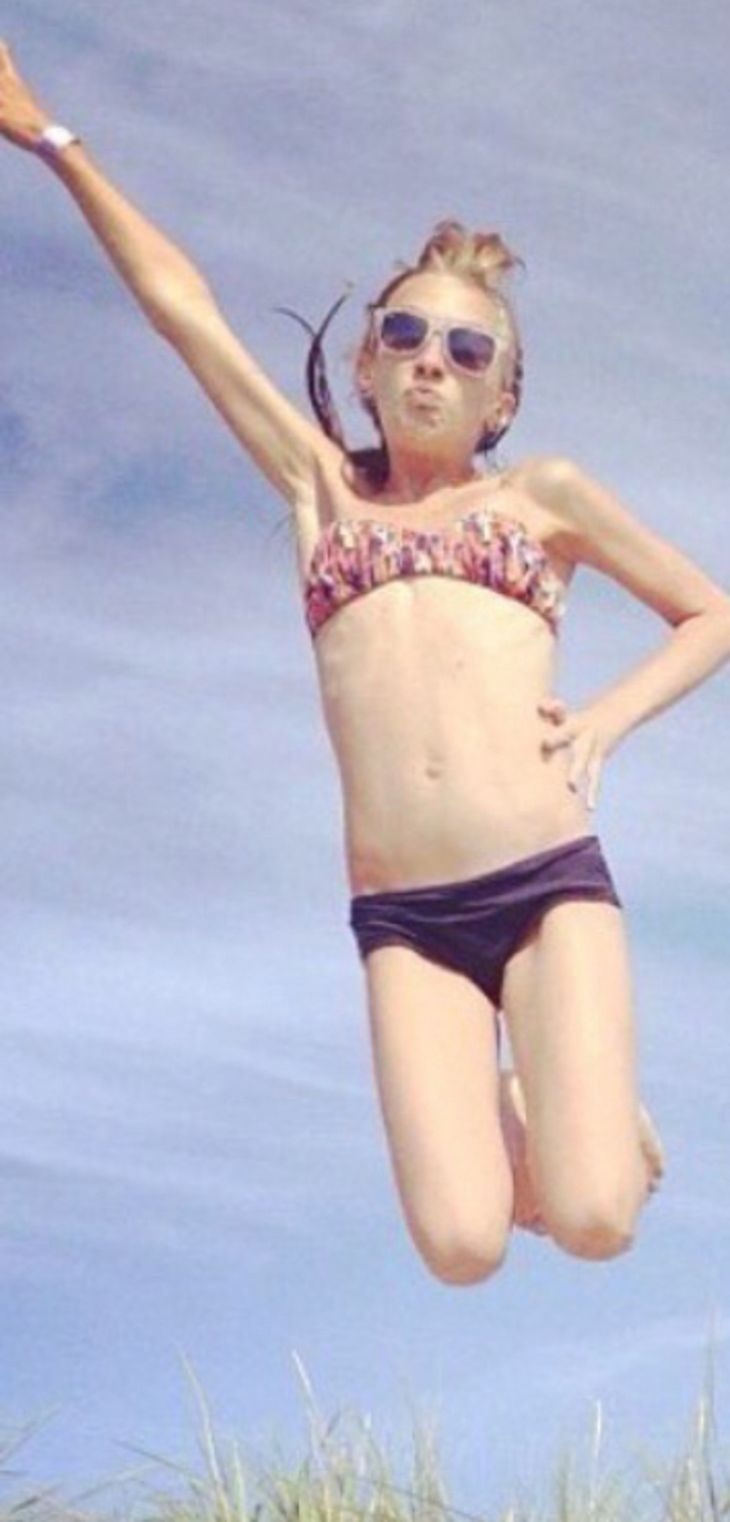 Her ses Amanda under sin periode med anoreksi som nærmest en streg i luften. (Foto: Amanda Kristiansen / MDWfeatures)