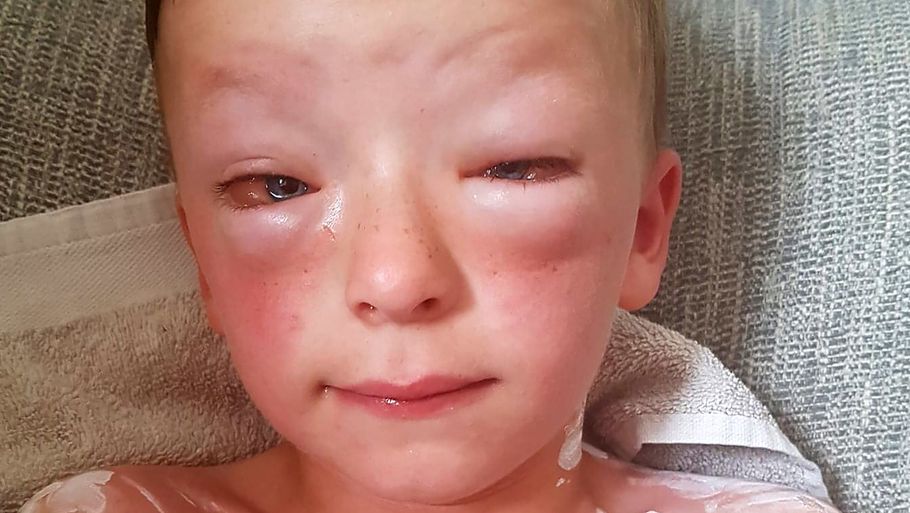 Den kun syv-årige Jay-Jay fik voldsomme hævelser i sit ansigt på grund af pollen-allergi. Han havde også udslæt over hele kroppen. (foto: Ritzau/Scanpix)
