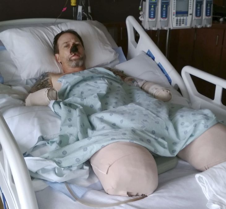 Greg Manteufel ses i sin hospitalsseng på Froedtert-hospitalet i Milwaukee, Wisconsin. Lægerne siger, at de var nødt til at amputere hans hænder og ben, efter at fik en sjælden blodinfektion fra en hund. Foto: AP