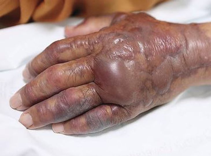 Ydersiden af hånden så også forfærdelig ud.(foto: New England Journal of Medicine)