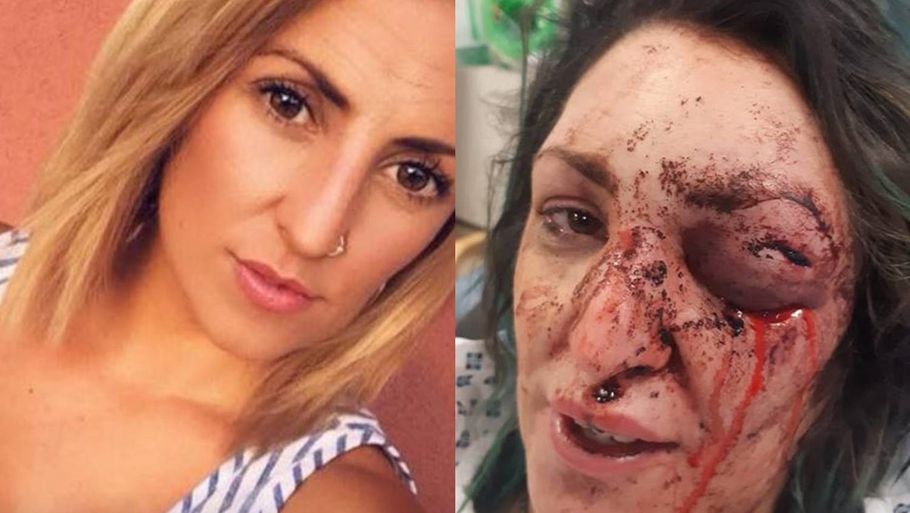 Jade Daniels' mor har delt et billedet af datterens ansigt efter det voldsomme stil-overfald. Foto: Jade Daniels/Daily Post Wales