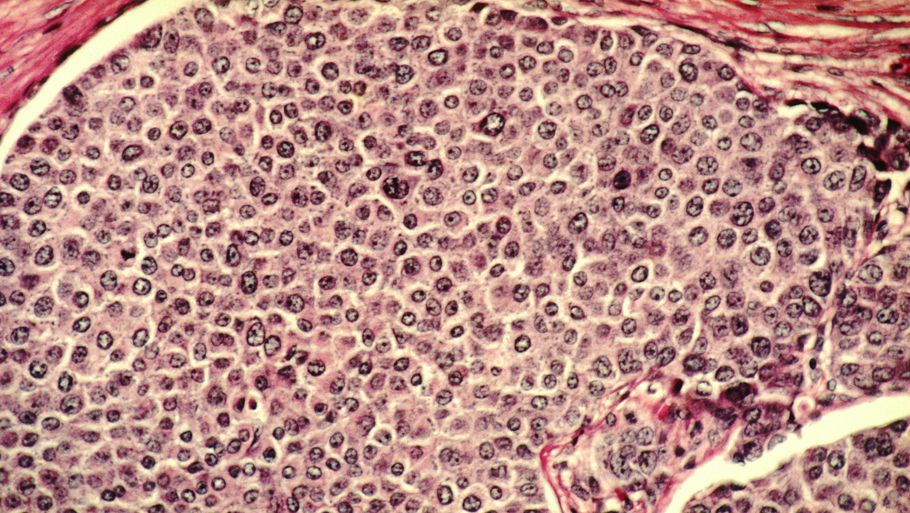 Fotografi af kræftceller, der har invaderet væv i et bryst. (Dr. Cecil Fox - The National Cancer Institute)