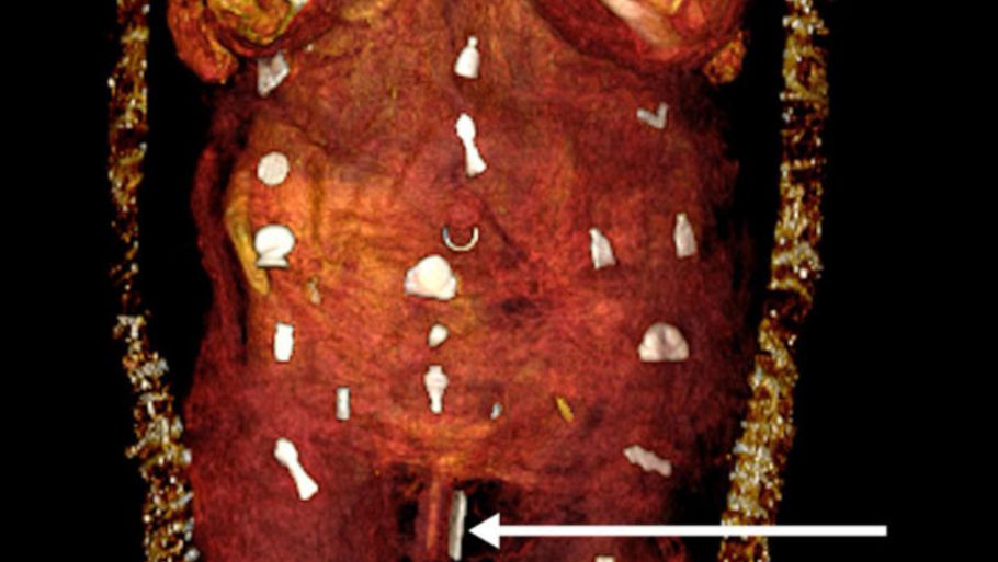 Ved siden af drengens intakte penis var der placeret en amulet, som forestiller to fingre. (Foto: Sahar N. Saleem et al.)