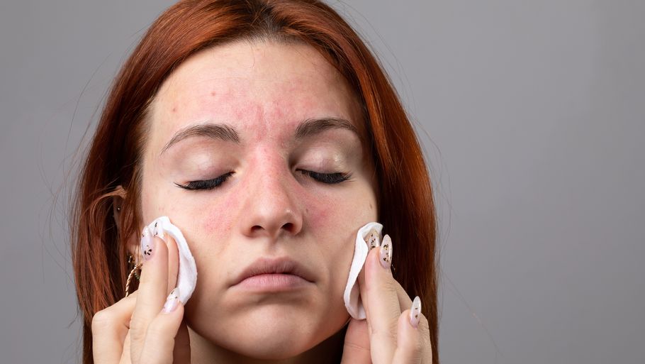 Hvis du har allergien, så er der helt konkrete ting, du kan gøre for ikke at blive generet af den. Foto: Getty Images