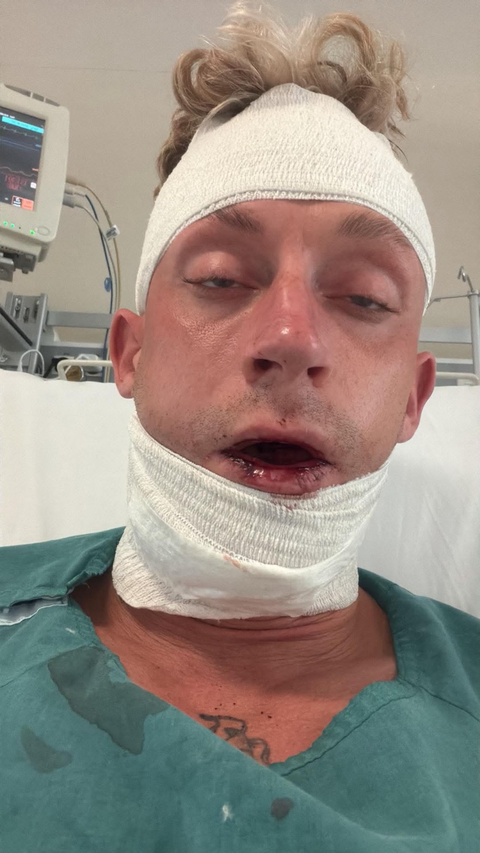 Smadret kæbe og tænder slået ud: Kevin 'Bro' Andreasen brutalt overfaldet and Tyrkiet – Ekstra Bladet